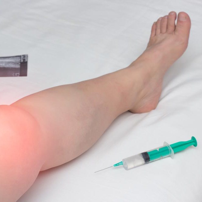 The inflamed leg of a woman with an affected knee joint from arthrosis and arthritis lies next to a syringe with Gilauri acid and a Honndroprotector, medical